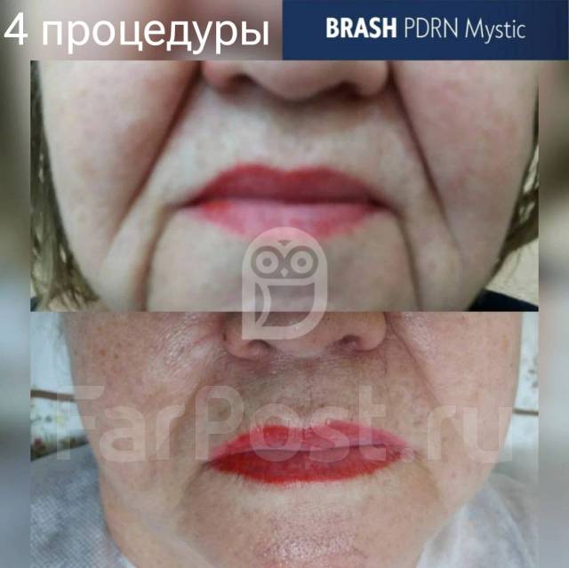 Пдрн фото до и после отзывы