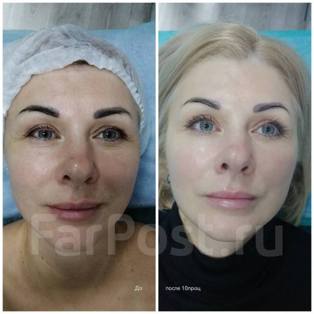 Скульптурный массаж лица до и после