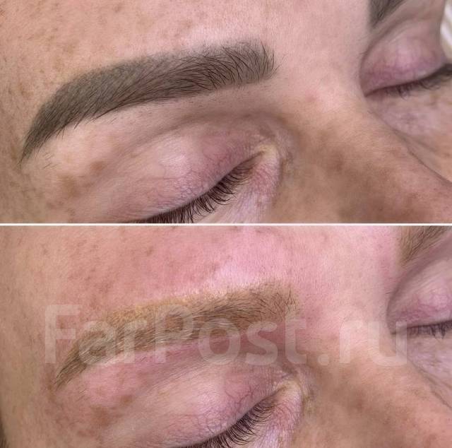 Удаление татуажа бровей губ лазером и ремувером в Артеме