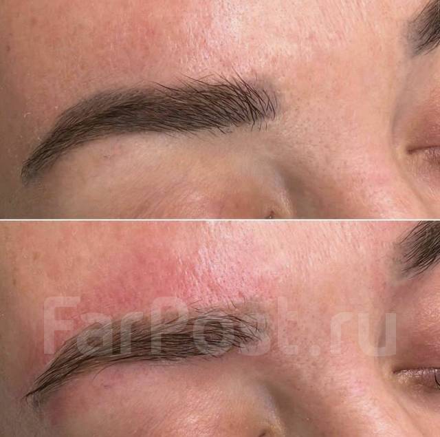 Удаление татуажа бровей губ лазером и ремувером в Артеме