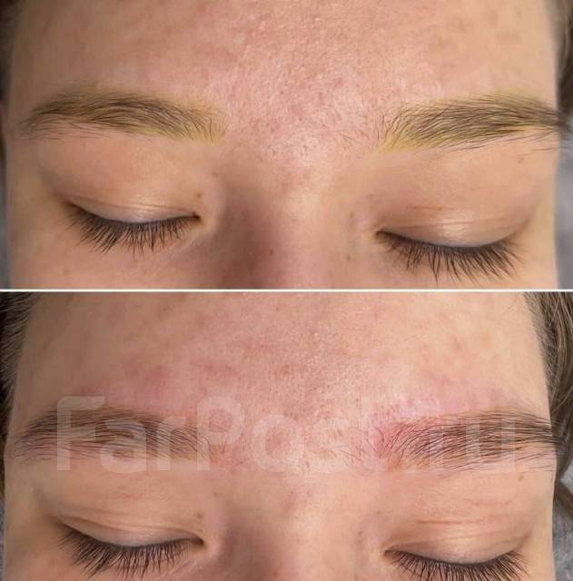 Удаление татуажа бровей губ лазером и ремувером в Артеме