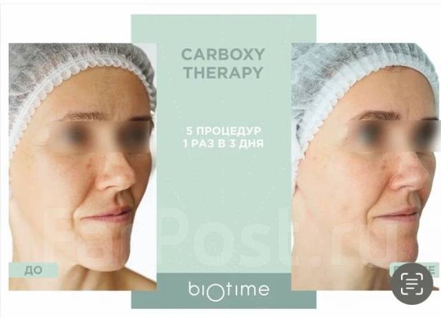 Лифтинг за час всего 2000р. Гипсовое моделирование. Карбокситерапия во ...