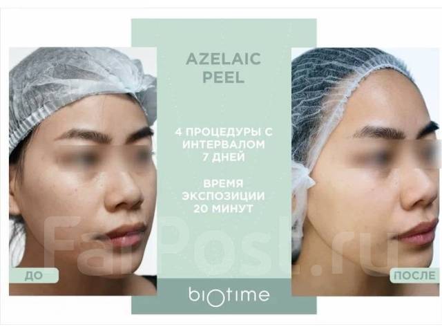 Лифтинг за час всего 2000р. Гипсовое моделирование. Карбокситерапия во ...