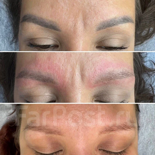 Лазерное удаление татуажа перманента тату во Владивостоке