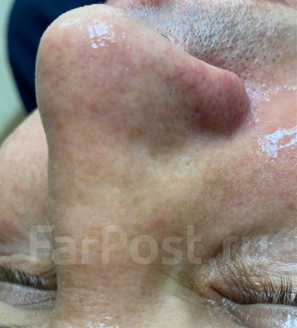 Чистка лица, лифтинг, пилинг Biorepeel во Владивостоке